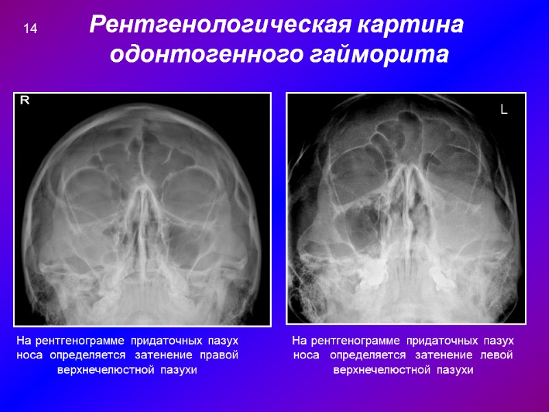 Рентгенологическая картина  одонтогенного гайморита L На рентгенограмме придаточных пазух носа  определяется 